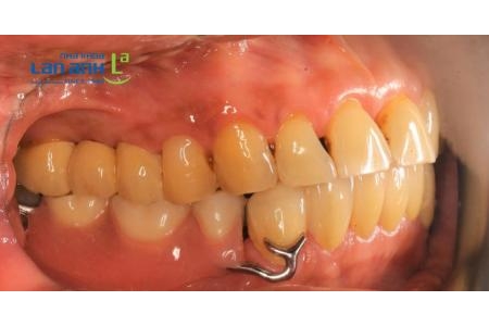 Ưu điểm của trồng răng bằng hàm tháo lắp