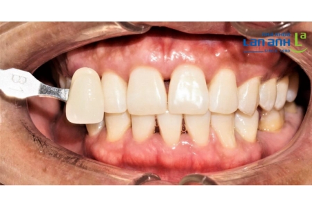 Tẩy trắng răng bằng hệ thống Zoom, đưa màu răng từ A3 lên màu B1 chỉ trong 60 phút