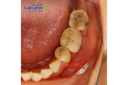 Thêm 1 răng sâu lớn bể vỡ được bọc lại để “gia cố” tại nha khoa Lan Anh