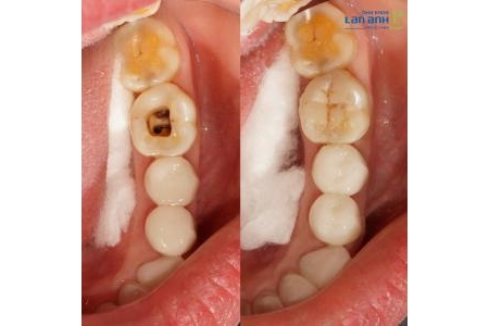Khi nào thì răng chữa tủy có thể trám lại mà không cần bọc sứ?