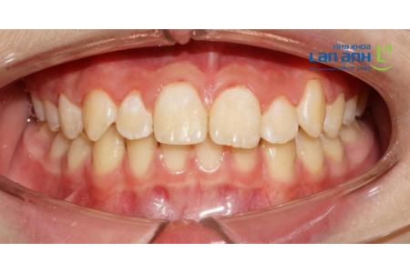 Cạo vôi răng không phải thủ thuật đơn giản