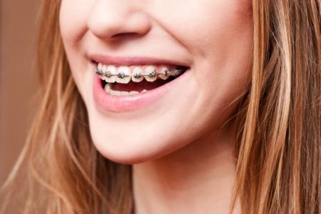 Có nên niềng răng, nhổ răng trước Tết không?