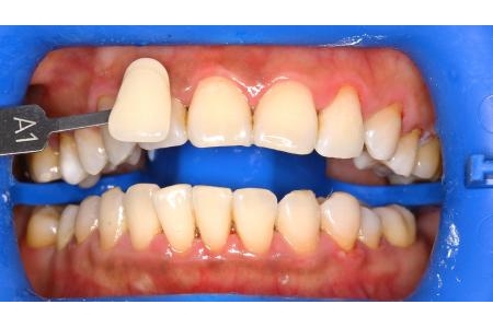 Tẩy trắng răng thông thường có đạt hiệu quả như tẩy trắng bằng Zoom không?