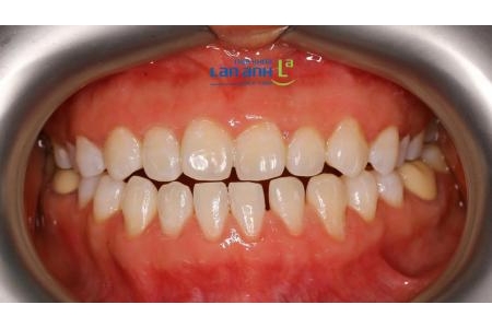 Răng sậm màu quá có tẩy trắng đạt hiệu quả không bác sĩ ?
