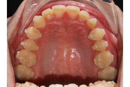 Kết quả sau 2 năm niềng răng bằng khay trong suốt