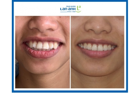 Niềng răng Invisalign cho trường hợp khó