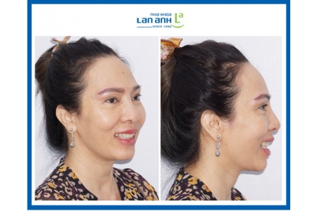 Câu hỏi thường gặp về niềng răng