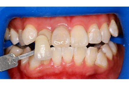 Tẩy trắng răng bằng hệ thống Zoom