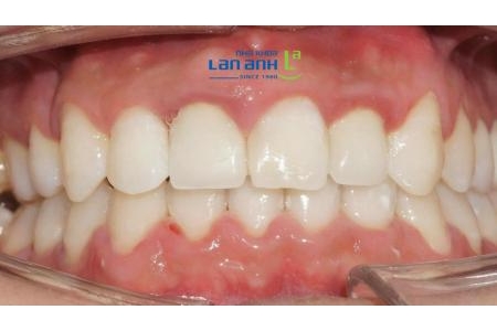 Răng sứ trắng hơn so với răng thật thì nên làm gì?