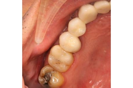 Chọn màu thỏi sứ cho phục hồi răng bị bể vỡ