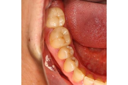 Xử lý thế nào khi răng bị mòn nhiều?