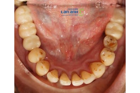 Giải pháp phù hợp khi mất răng nhiều