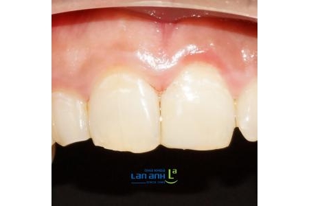 Răng cửa bị mẻ có thể trám thẩm mỹ thay vì bọc sứ được không?