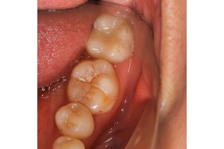 Trám răng ở bên trong như thế nào?