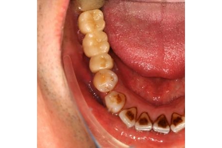 Đặt implant sao cho lành thương nhanh chóng?