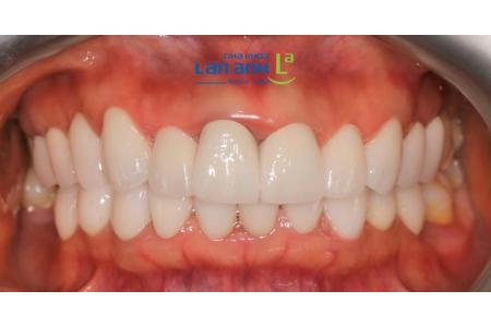 Làm răng sứ cần chú ý những gì?