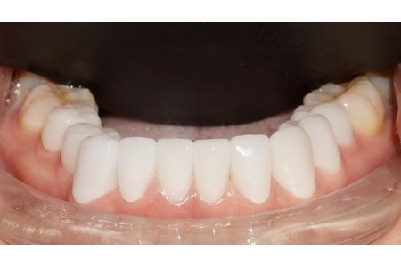 Phục hình theo phong cách tự nhiên