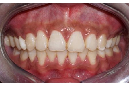 Phối hợp tốt để kết quả niềng răng đẹp