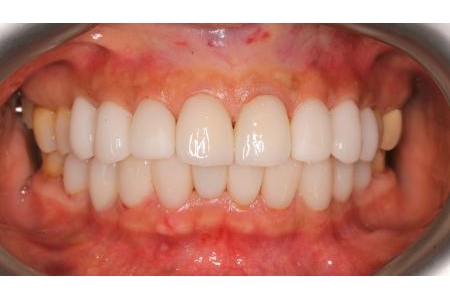 Răng sứ có nhất thiết phải trắng mới đẹp?