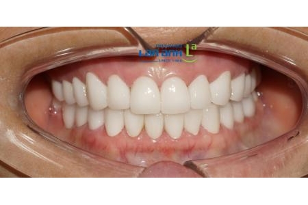Độ bền răng sứ phụ thuộc vào 