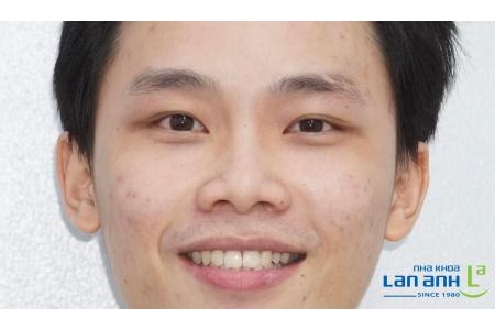 Niềng răng Invisalign có đạt kết quả tốt không?