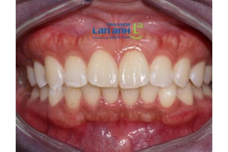 Niềng răng hàm dưới