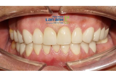Răng sứ giống răng thật