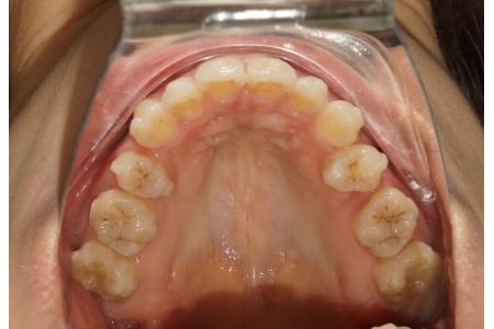 Những ngộ nhận về niềng Invisalign