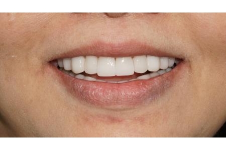 Chọn lựa vật liệu sứ cho phù hợp bệnh nhân