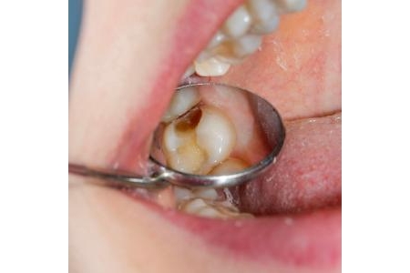 Khi nào răng bị sâu đến mức phải điều trị tủy răng?