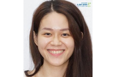 Câu chuyện bệnh nhân đã điều trị ung thư mong muốn được niềng răng