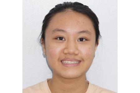 Niềng răng cho trẻ em cần đúng thời điểm phát triển