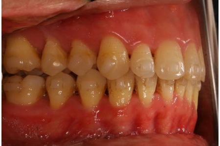 Niềng răng Invisalign điều trị hô