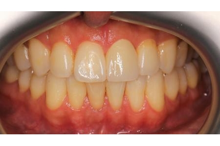 Phục hồi 1 răng cửa bị bể