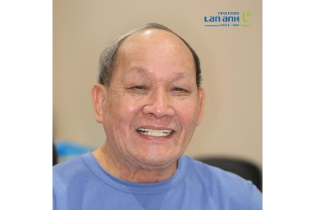 Khi răng bị hư nhiều, thì làm lại có khó lắm không?