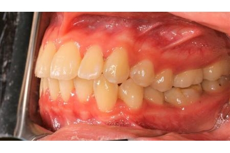 Bọc răng đúng kỹ thuật để sử dụng lâu dài