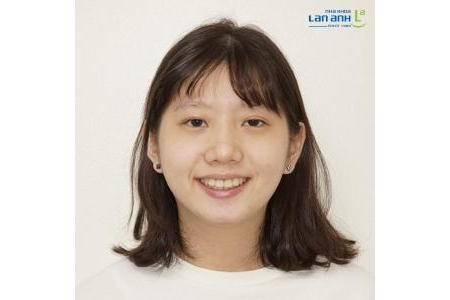 Niềng răng hiện đại là chỉ niềng khi cần thiết