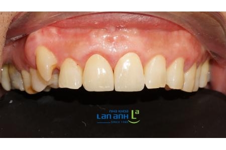 Răng sứ có thể làm giống y chang răng thật kế bên được không?