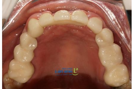 Thay hàm tháo lắp bằng Implant