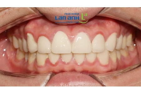 Răng sứ bị viêm nướu vì lý do gì?