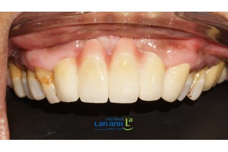 Cầu răng sứ cho trường hợp mất răng do tai nạn