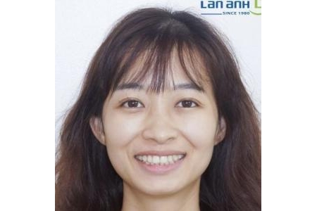 Niềng răng mà vẫn ăn nhai được tốt