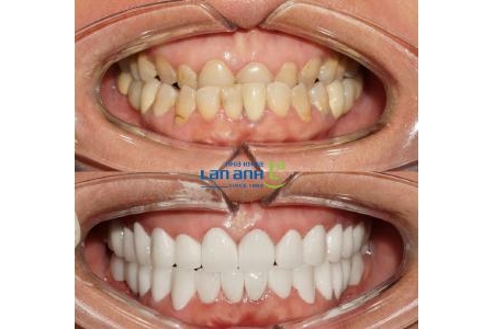 Phục hình cho trường hợp khớp cắn ngược