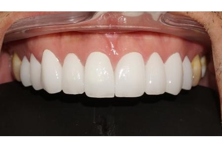 Chọn màu răng sao cho phù hợp với phong cách của bạn