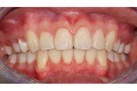 Niềng răng vừa xếp đều răng khểnh vừa giảm hô