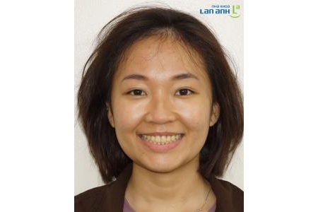 Niềng răng Invisalign hiệu quả cao