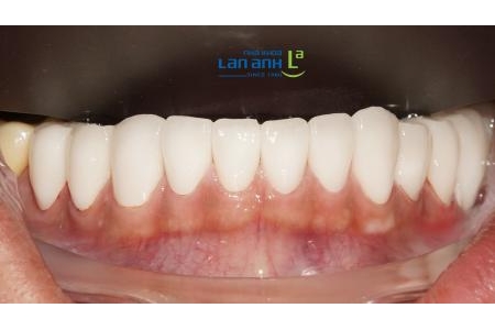 Làm răng sứ răng cửa dưới khó như thế nào?