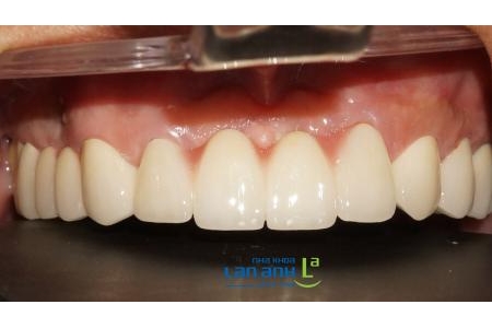 Răng sứ sau 10 năm sử dụng sẽ như thế nào?
