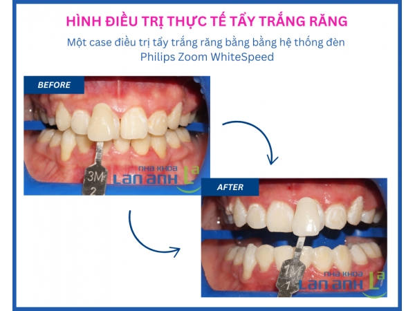Tẩy trắng răng