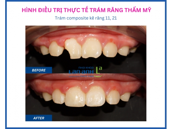Trám răng thẩm mỹ